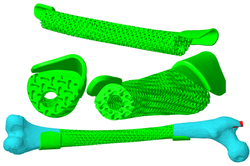 The CAD model of the Femur Implant with Lattices.